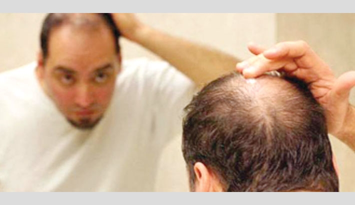 Why Short Men Are More Likely to Go Bald